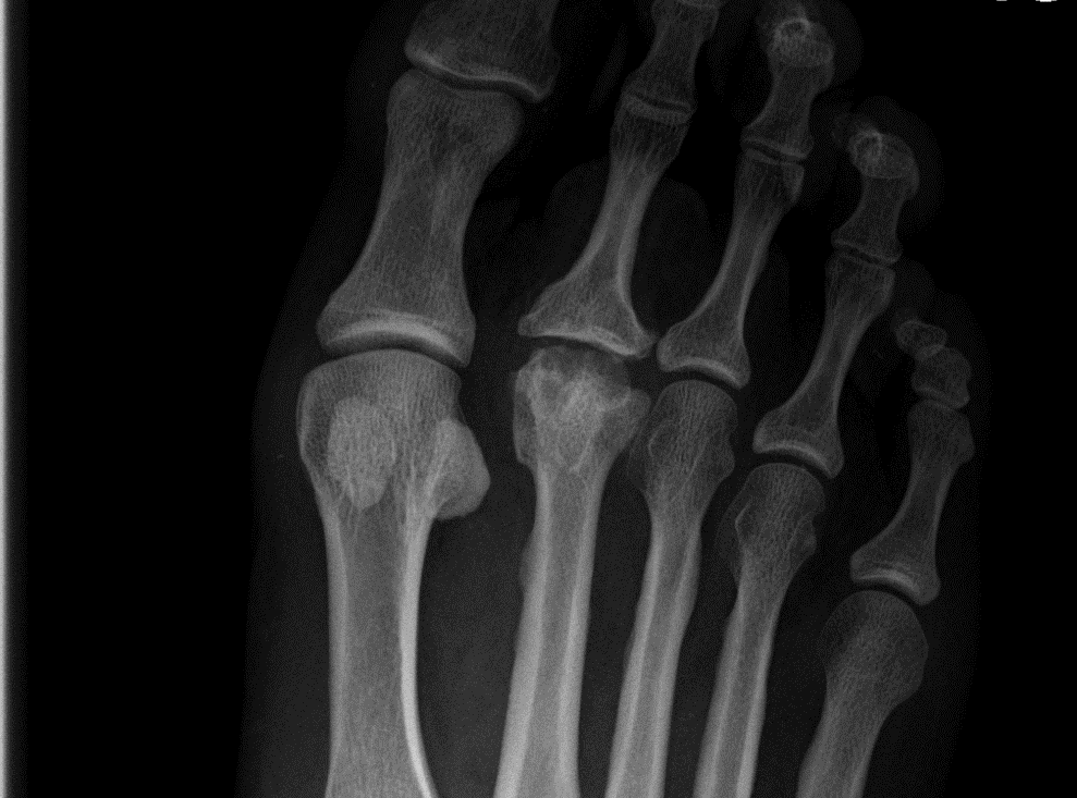 Láb betegségek Láb metatarsalis artrosis kezelés